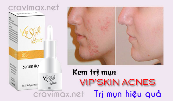 ưu điểm vip'skin acnes